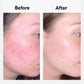 Results from customers using Nordic Oil's cbd acne cream